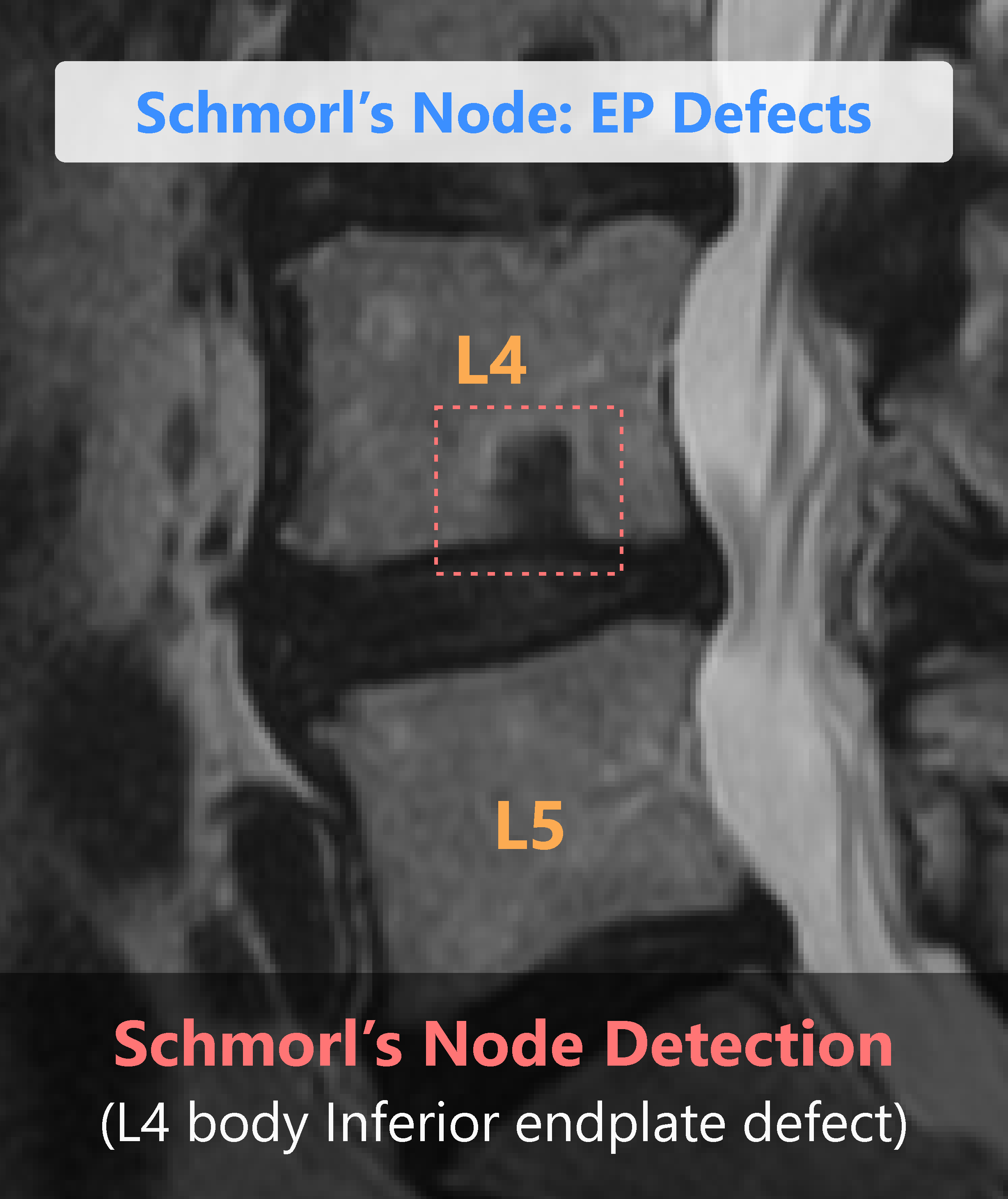 Schmorls Nodes